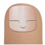 Инструменты и материалы для коррекции вросшего ногтя