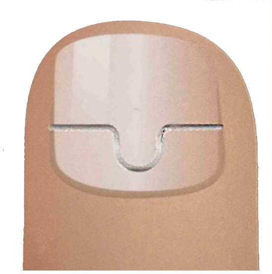 Инструменты и материалы для коррекции вросшего ногтя